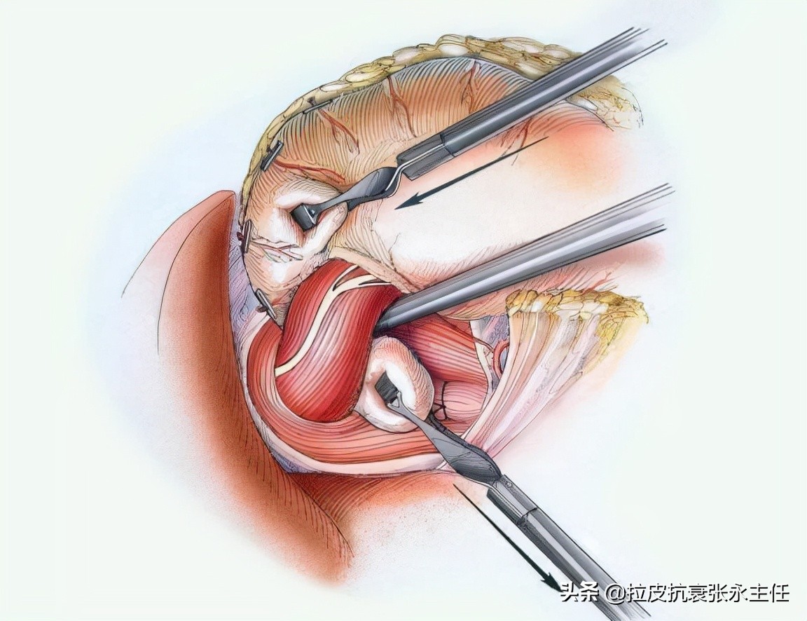 内窥镜小切口面部除皱术多少钱,微创内窥镜除皱副作用