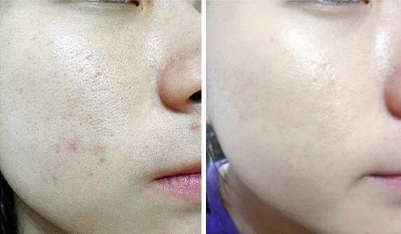 亲测真正有效去黑头粉刺产品,黑头连根拔起还会再长吗