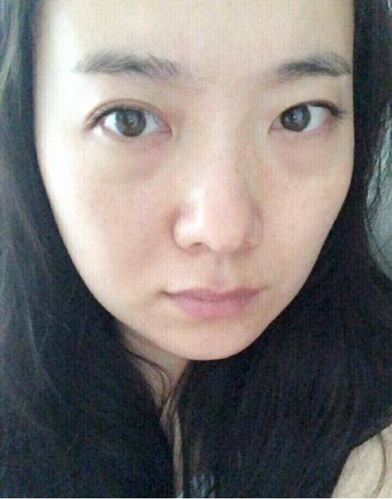 热玛吉术后注意事项和护理,做完热玛吉怎么护理效果最好