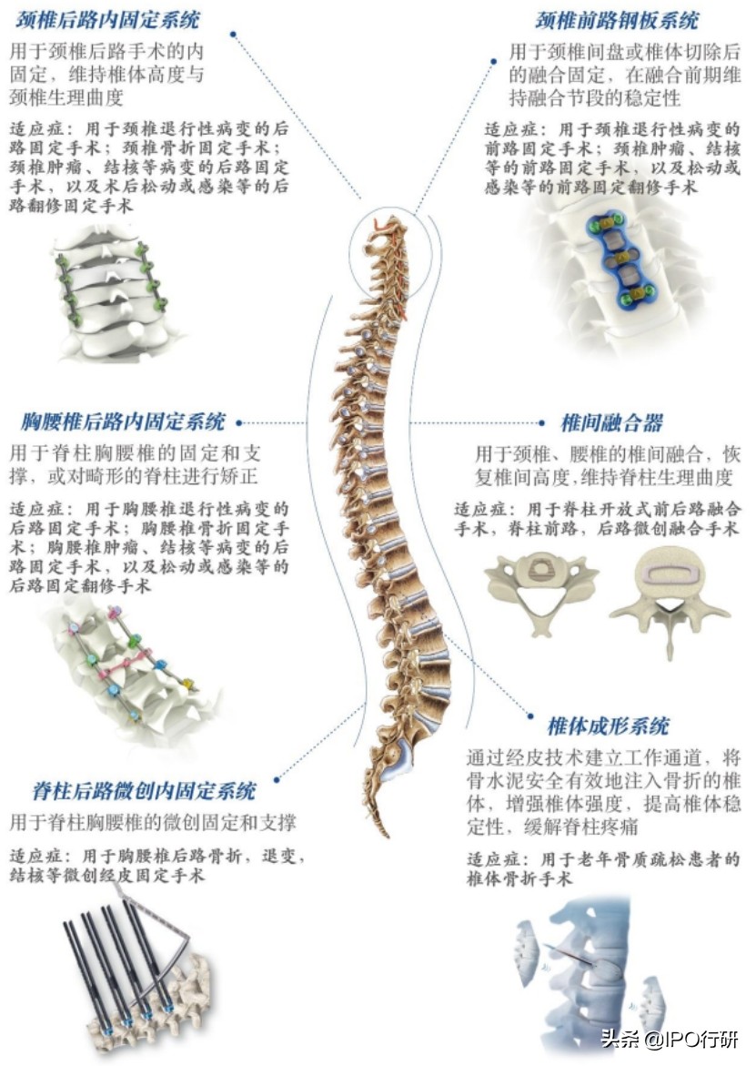中国骨科植入物排名,骨科植入效果怎么样